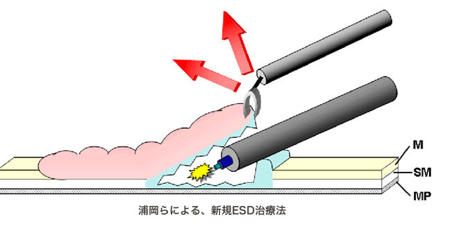 浦岡らによる、新規ESD治療法イラスト